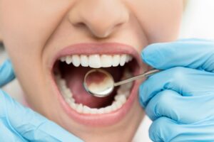 annapolis dental care oral cavities