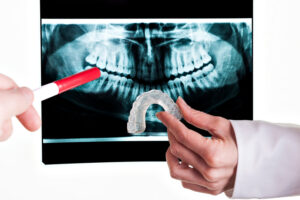 annapolis dental care dental x-rays