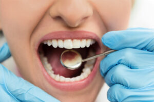 The Role of Genetics in Dental Health